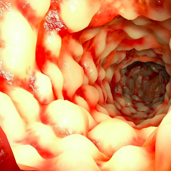 amestecul lui Crohn